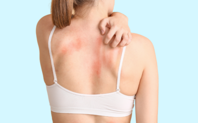 How to Get Rid of Body Acne (Backne)
