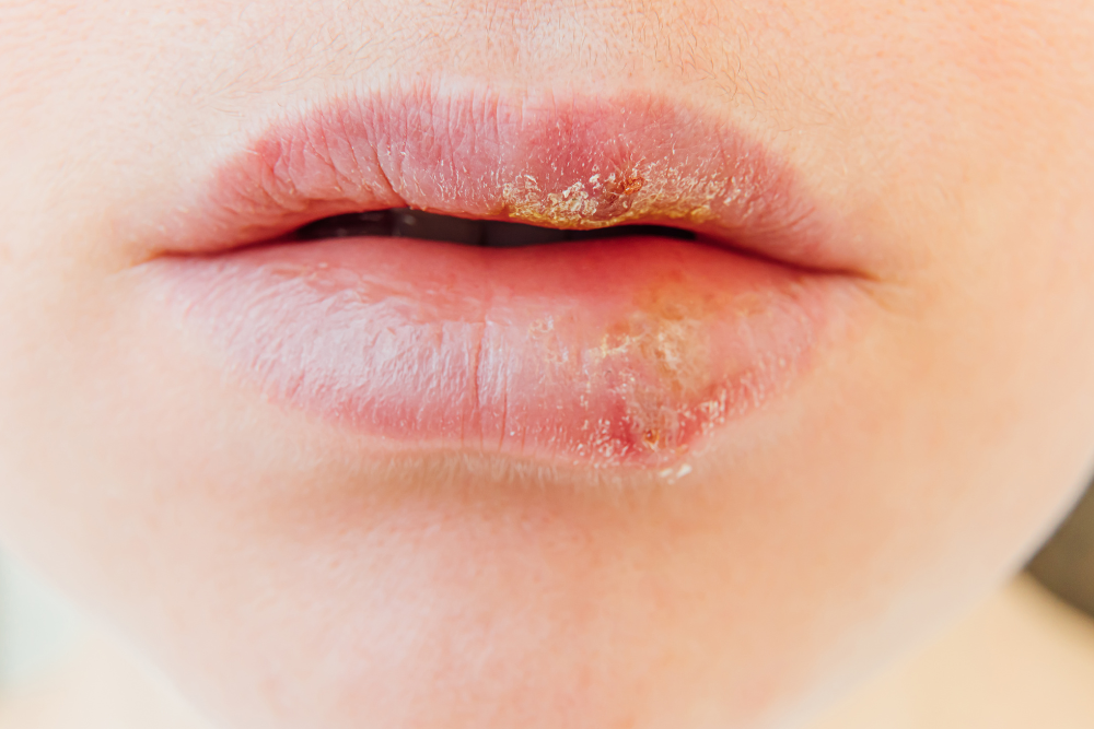 Herpes symptoms - cold sore on lips