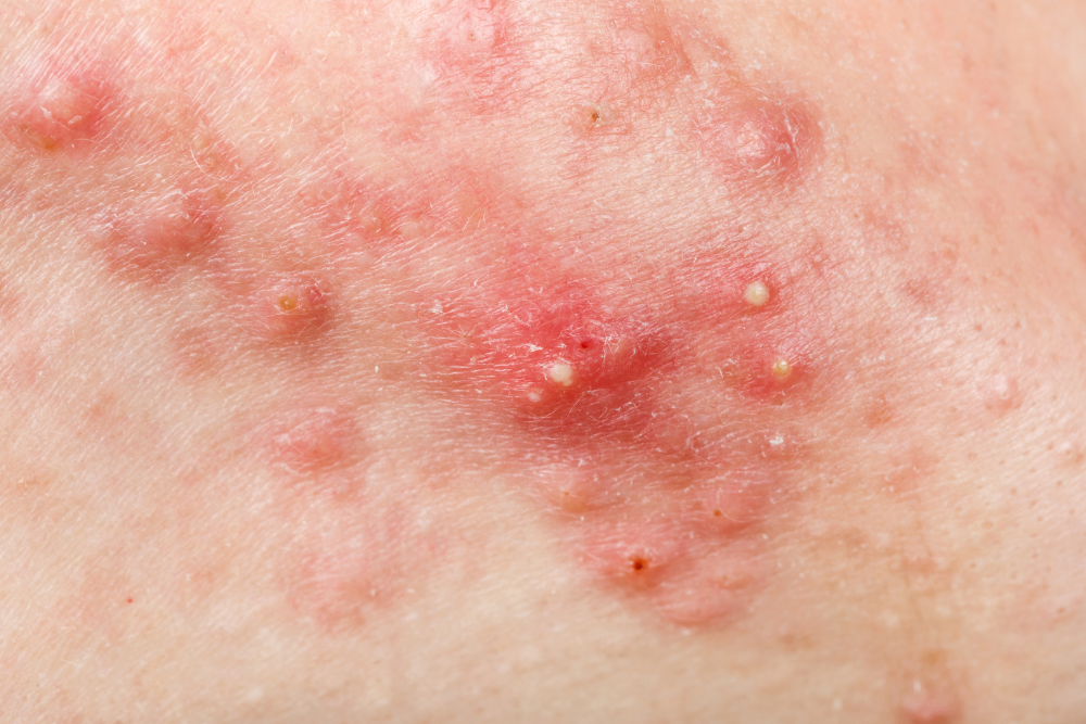 Cystic acne and pustules.