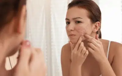 What’s The Best Treatment for Acne Scars?