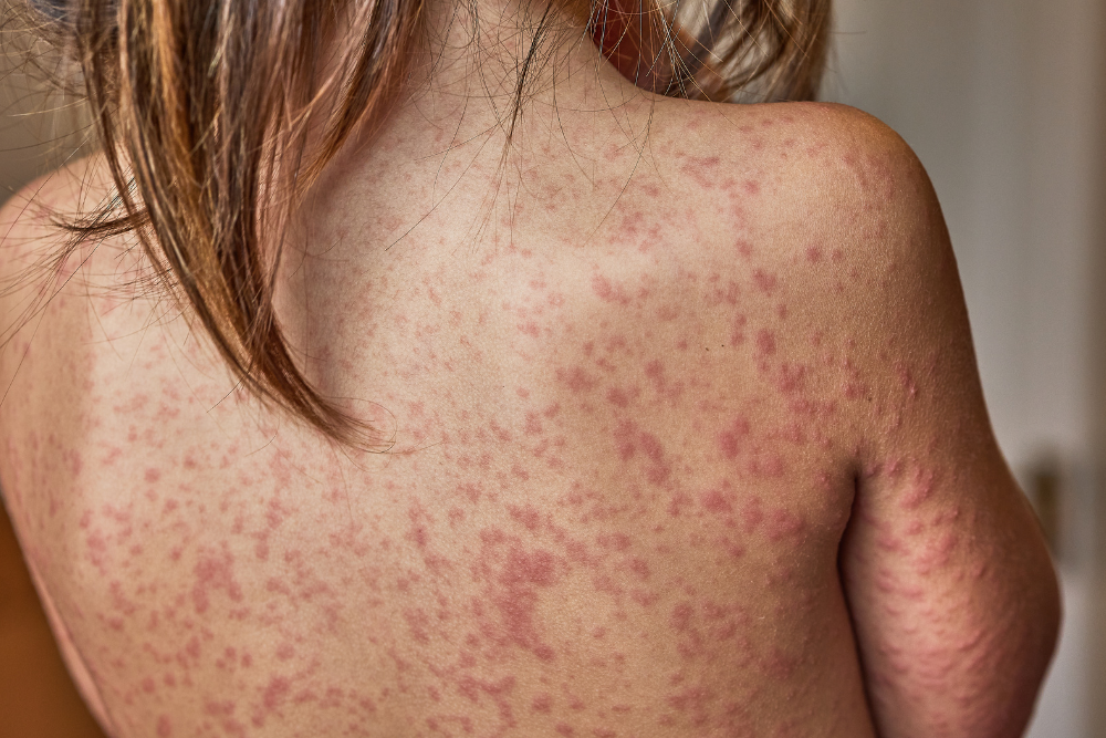 Contact dermatitis on back.