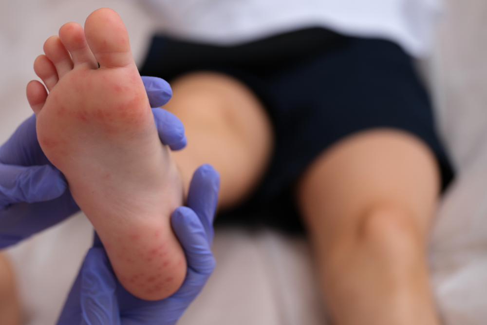 The symptoms of hand, foot and mouth disease - blisters on feet.