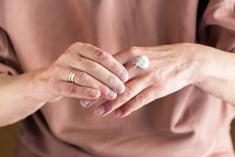 A person rubbing eczema cream on her atopic dermatitis.