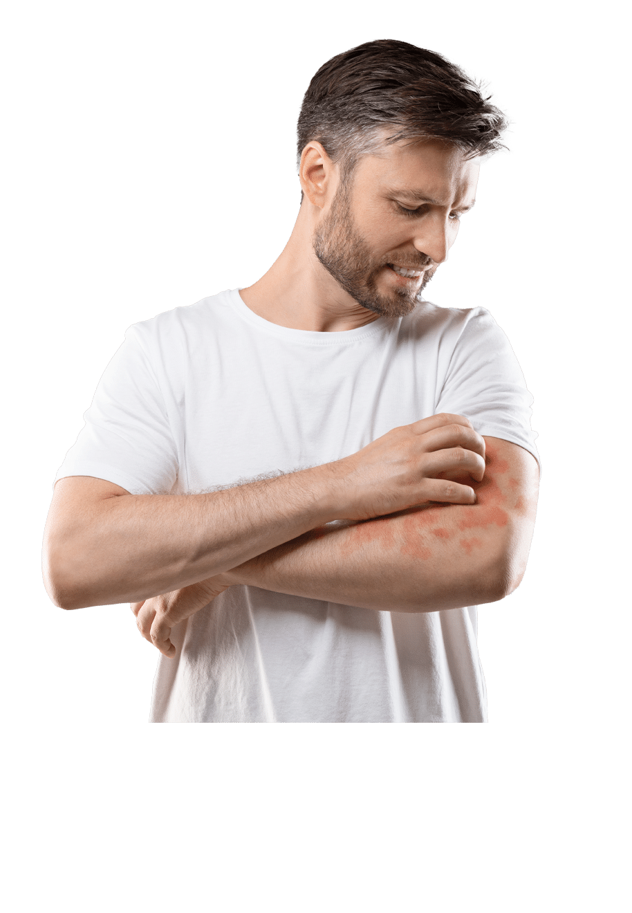 eczema