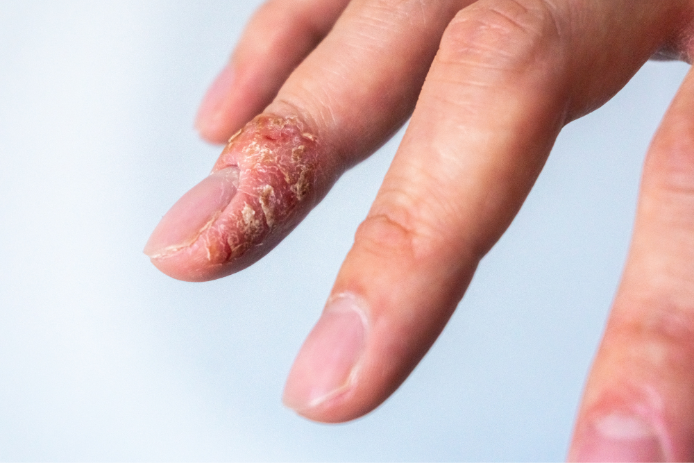 Eczema on hands.