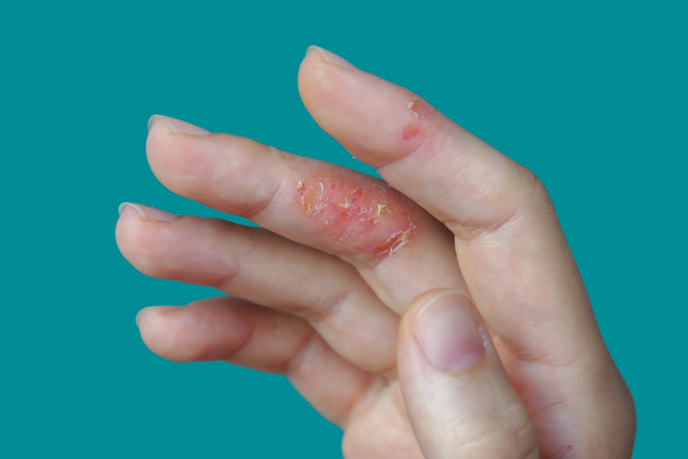 atopic dermatitis, symptoms of hand eczema, more than dry skin