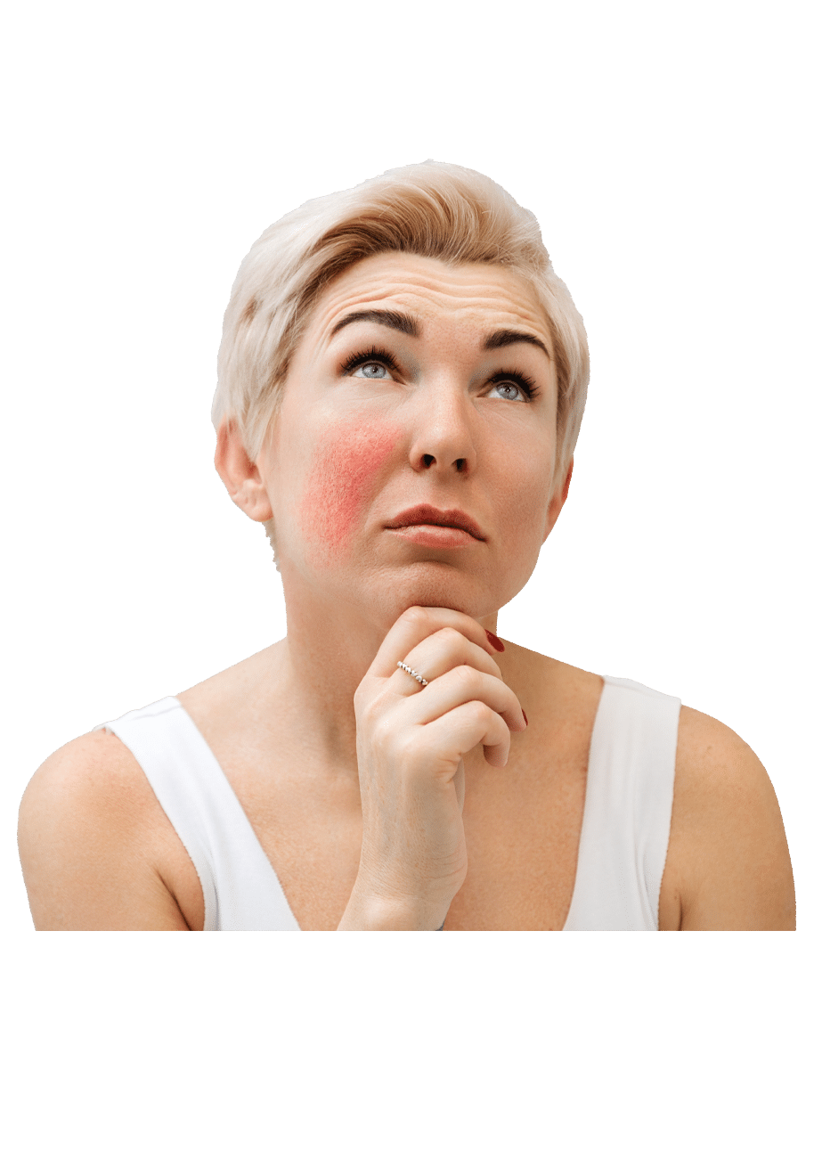 rosacea