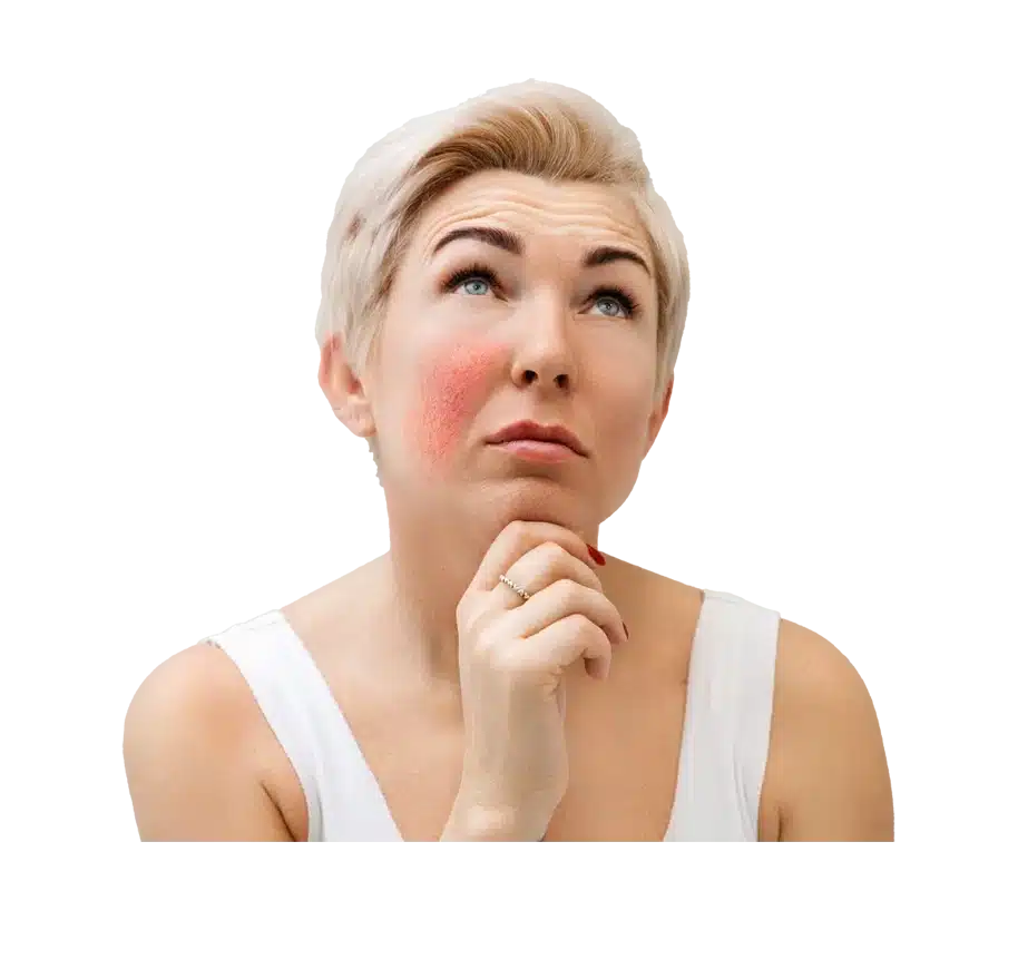 rosacea.png