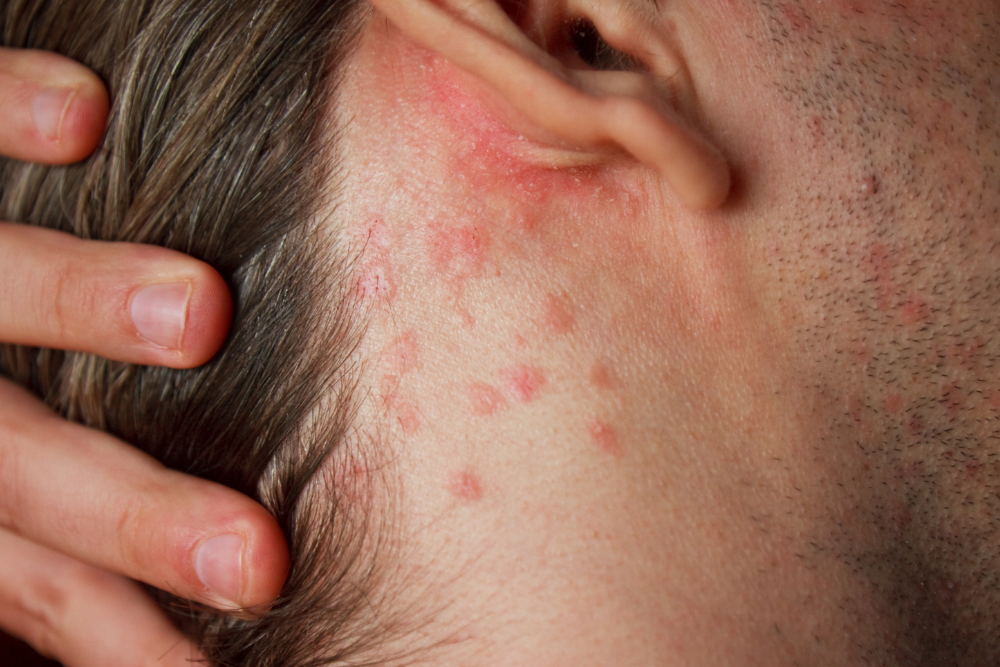 Skin inflammation - eczema behind the ears.