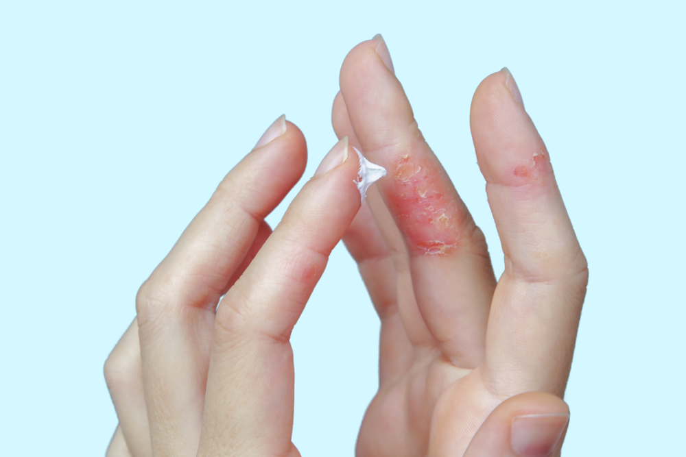 atopic dermatitis, developing hand eczema, painful hands